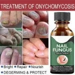 Nail Fungus Treatment Gel Pakistan for smooth healthy-looking nails