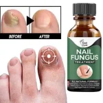 Nail Fungus Treatment Gel Pakistan for smooth healthy-looking nails