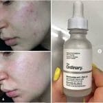 The Ordinary Niacinamide 10% + Zinc 1 % - 30ml - Image 5