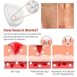 DermaSmooth Skin Tag Remover Patch – Fast, Safe, And Painless Skin Tag And Mole Removal Solution With No Scarring Or Pigmentation - Image 4
